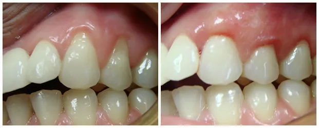 Connective Tissue Grafting Smiles smile gallery