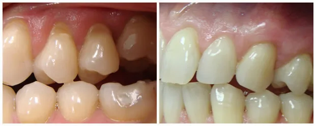 Gum Grafting Smiles smile gallery