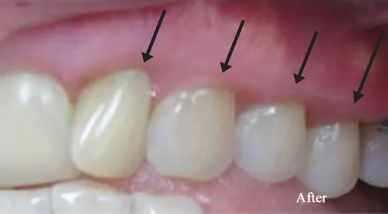 Pinhole Surgery Smiles smile gallery