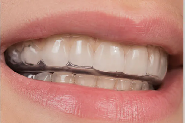 Custom-fitted bruxism night guard seated on the upper arch of a Toronto patient