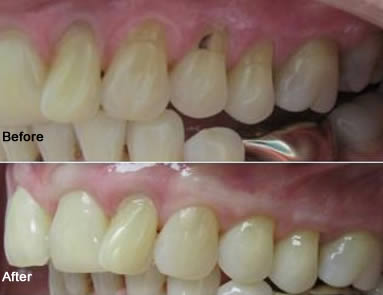 Chao Pinhole Surgical Technique — before the procedure