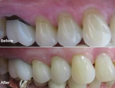 Chao Pinhole Surgical Technique — gum tissue gently repositioned