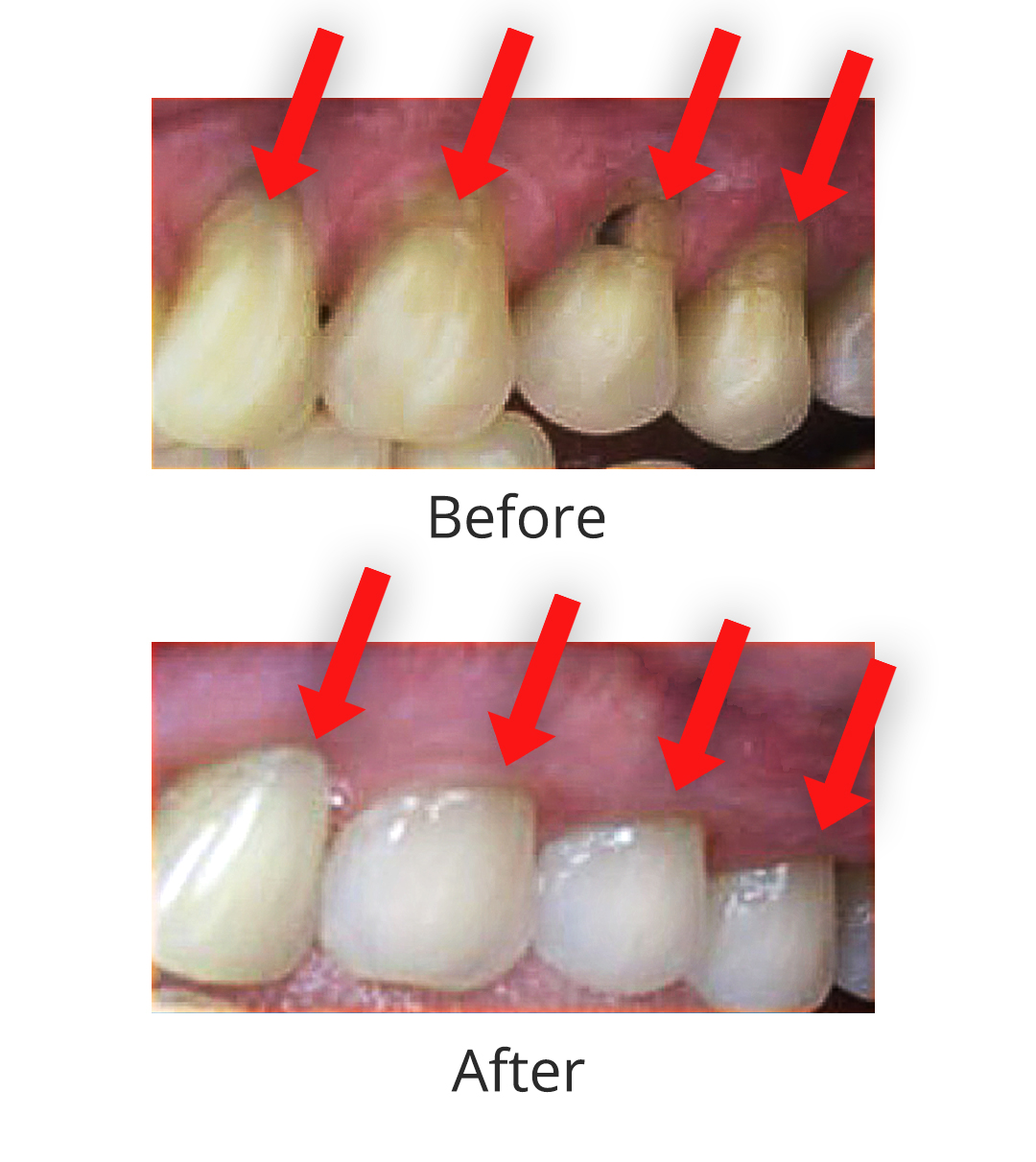Diagram showing gum recession exposing tooth roots