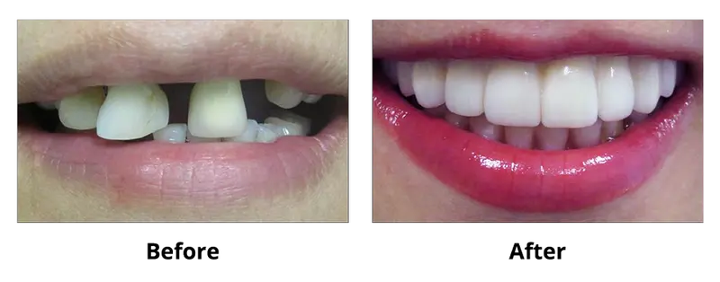 Implant Surgical and Prosthetic smile gallery