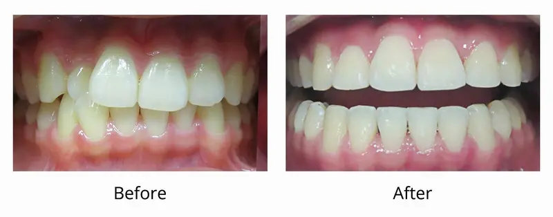 Invisalign Smiles smile gallery