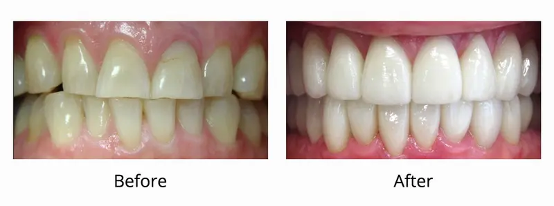 Lumineers & Veneers Smiles smile gallery