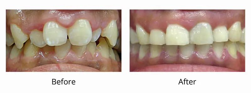 Invisalign Clear Aligners before and after — Dr. Yolanda Cruz Toronto