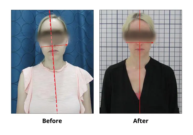Case 4: Asymmetrical Face — TMD / TMJ before-and-after at Dentistry On The Path