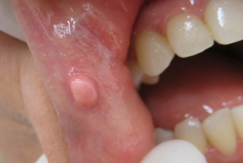 Mucocele before laser removal — small bump visible on the inside of the lip