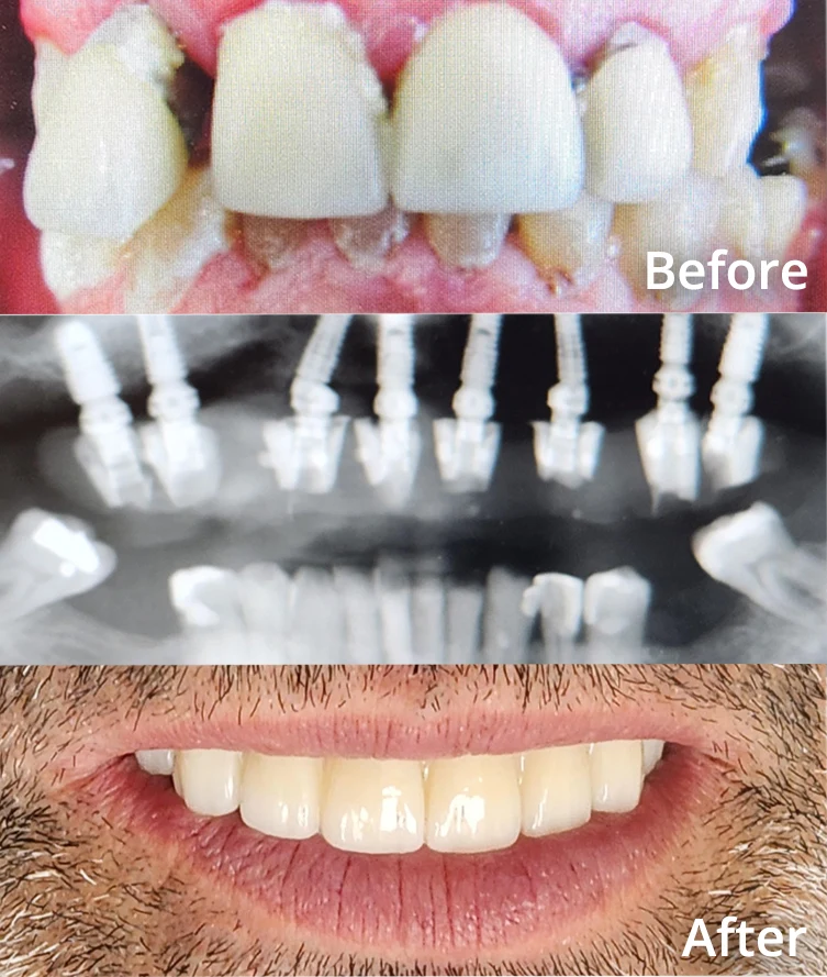 Before and after dental implant treatment at Dentistry On The PATH in Toronto