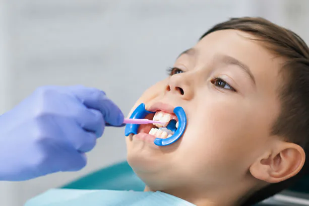 Dental sealants applied to teeth at Dentistry On The PATH