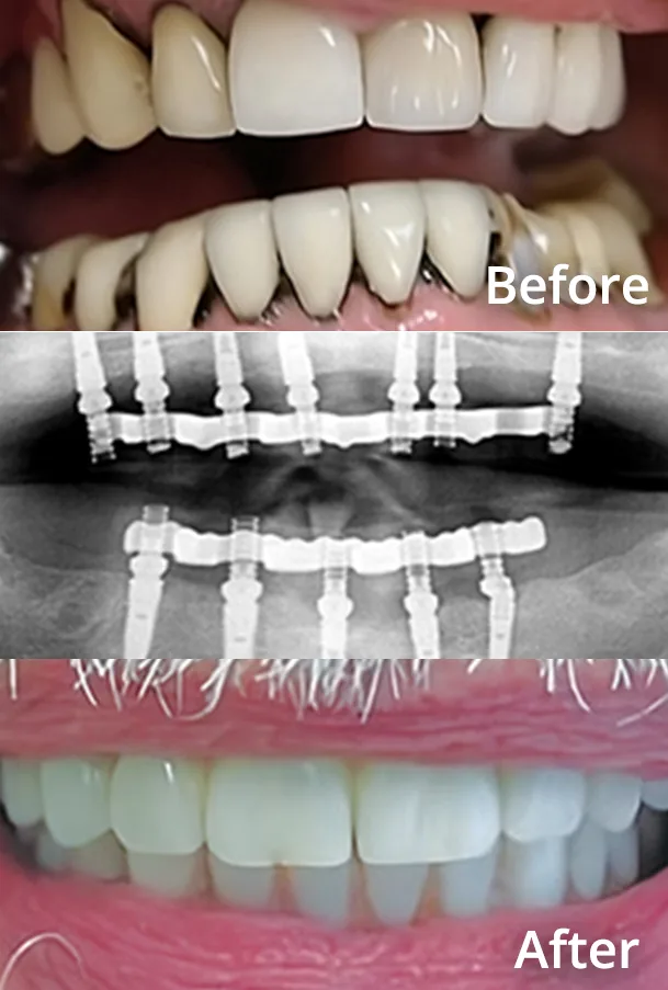 Before and after full-arch dental implant treatment showing failing teeth restored with an implant-supported fixed bridge, with X-ray of the placed implants