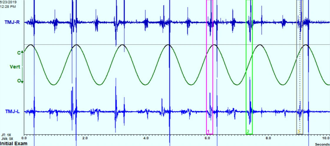 Joint Vibration Analysis (JVA) recording of TMJ joint vibrations at Dentistry On The PATH, downtown Toronto