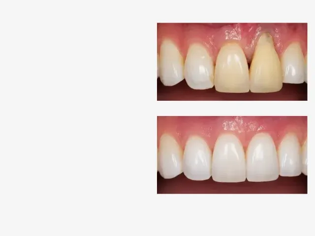 Pinhole Surgical Technique — Dr. Yolanda Cruz Toronto